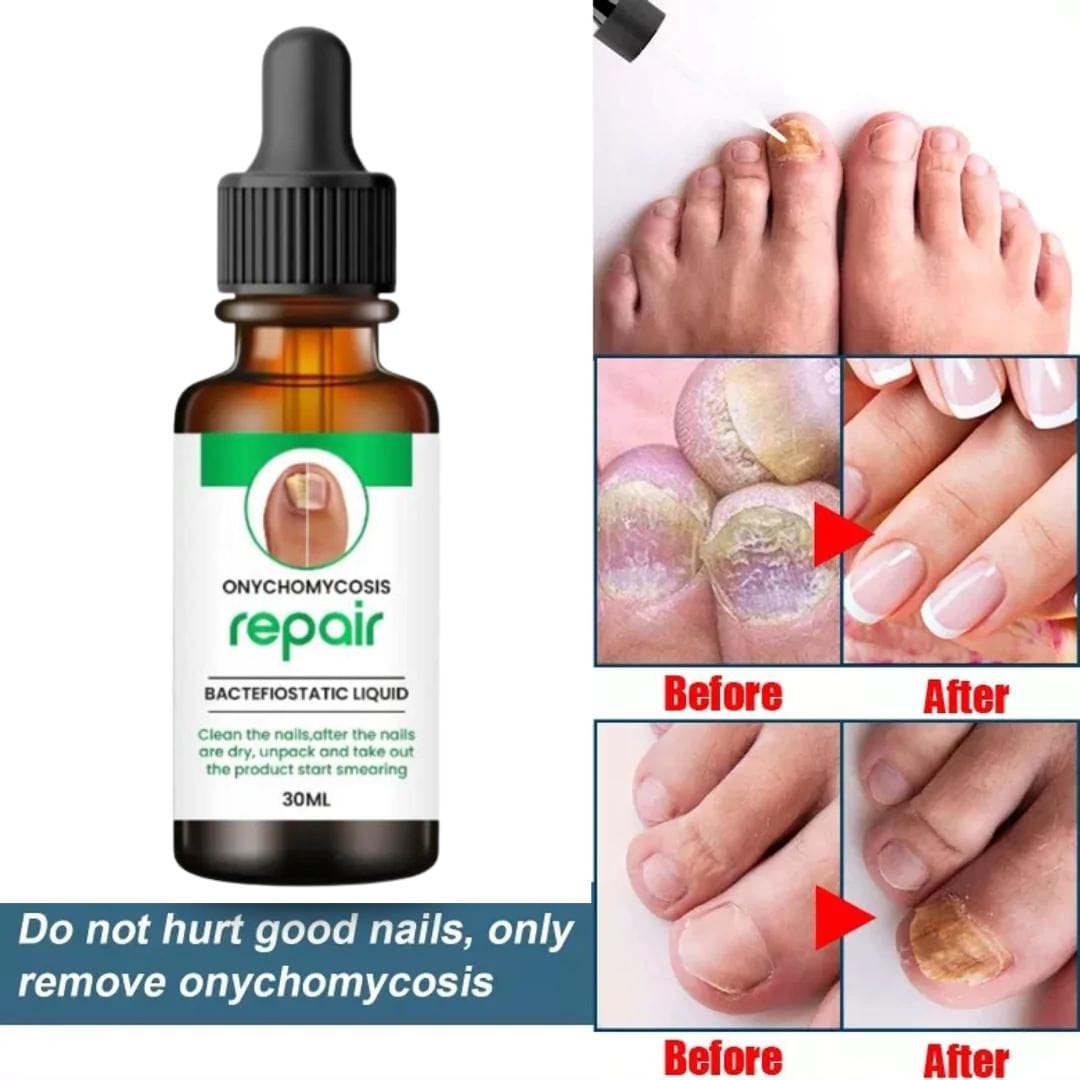 MD Professional All-in-One Nail Serum For Fungal Infection 🔥Buy 1 Get 2 Free🔥 - dmore