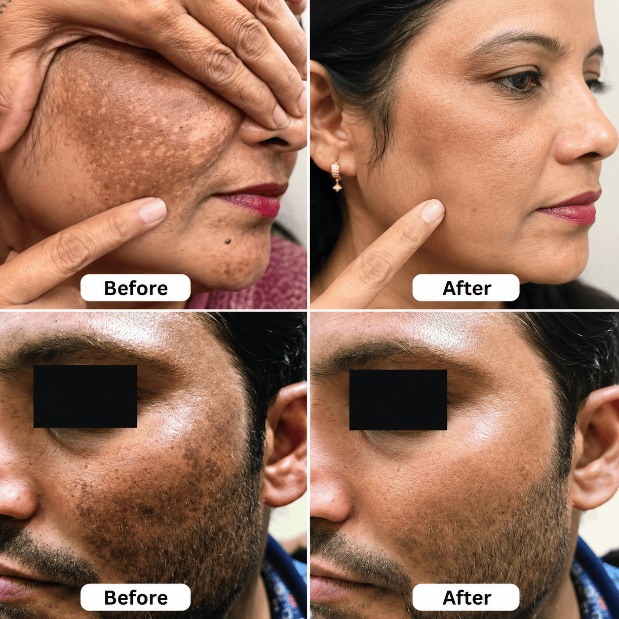 SD Turmeric Spot Corrector Serum🫚 Get result in just 7 days