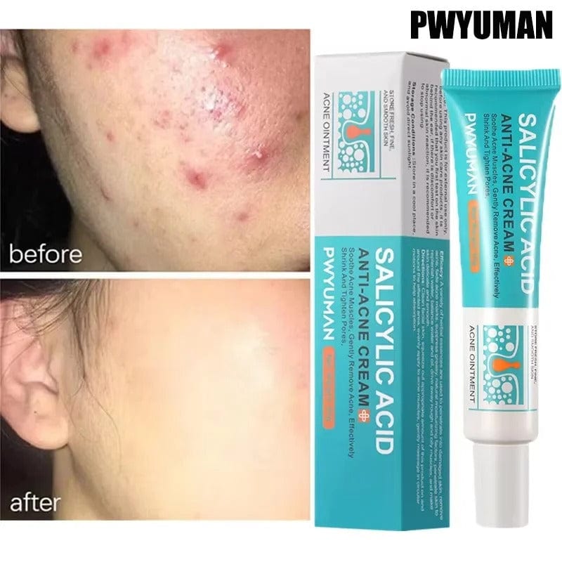 SC D-More Acne-Free Glow: Salicylic Acid Anti-Acne Cream 💧 - dmore