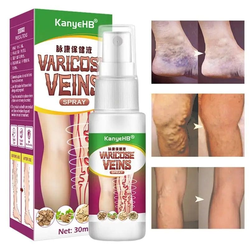 MD Herbal Varicose Vein Spray - Instant Relief & Vein Care Solution! 👨🏻‍⚕️ 💚 PACK 2