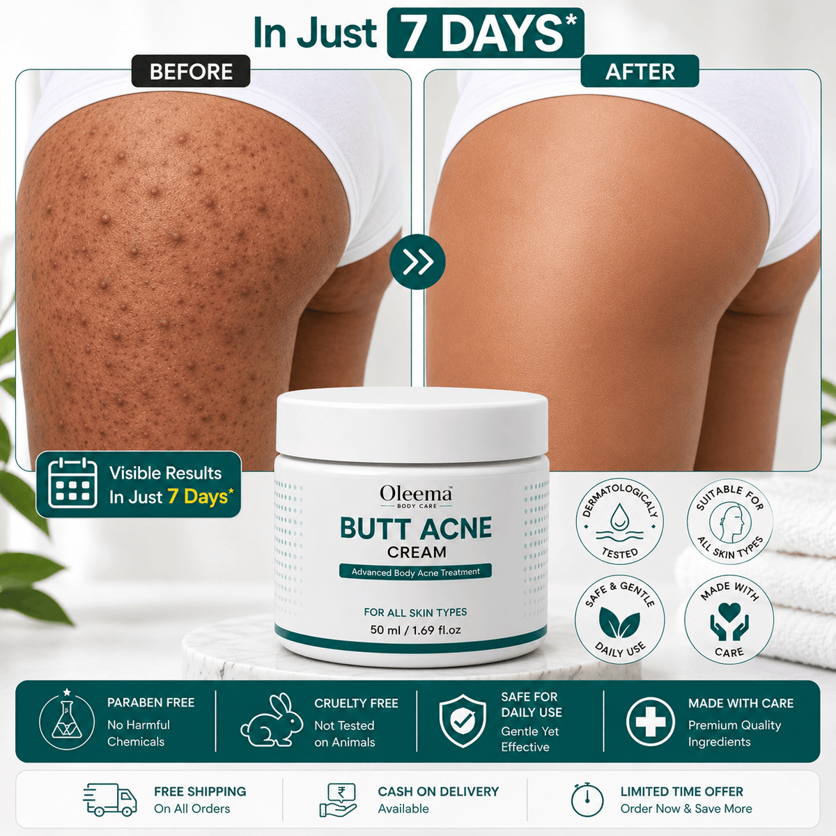 SD Butt Acne Cream For Bumps, Breakouts & Uneven Skin on Your Bum & Body