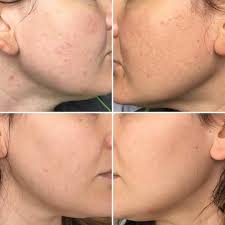 MD Orange Exfoliating Cleansing Pore Brightening Whitening Gel- Buy 1 Get 1 Free🔥🔥