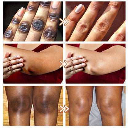 SD Acanthosis Nigricans Oil – The Herbal Solution for Dark Patches🌿 - dmore