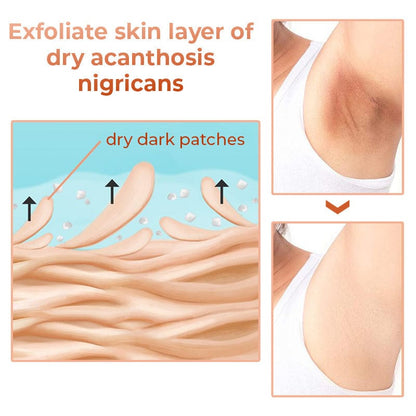 SD Acanthosis Nigricans Oil – The Herbal Solution for Dark Patches🌿 - dmore