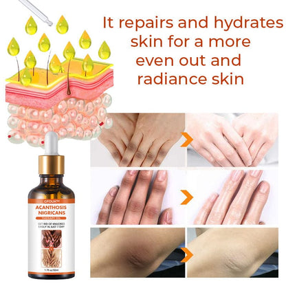 SD Acanthosis Nigricans Oil – The Herbal Solution for Dark Patches🌿 - dmore