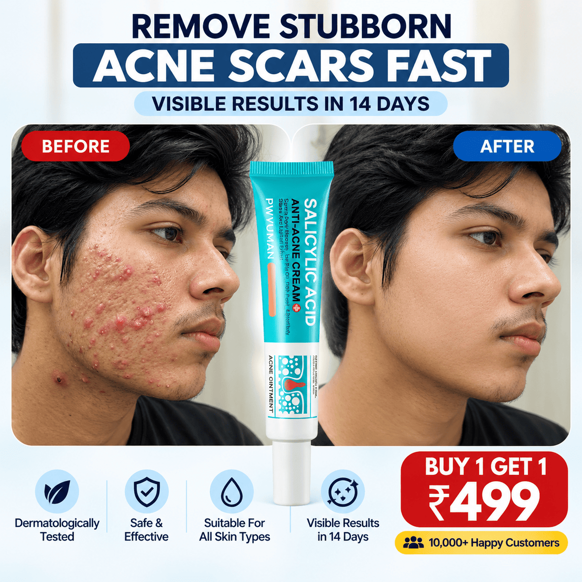 SD Salicylic Acid Anti-Acne Cream 💧 :  Acne-Free Glow - dmore