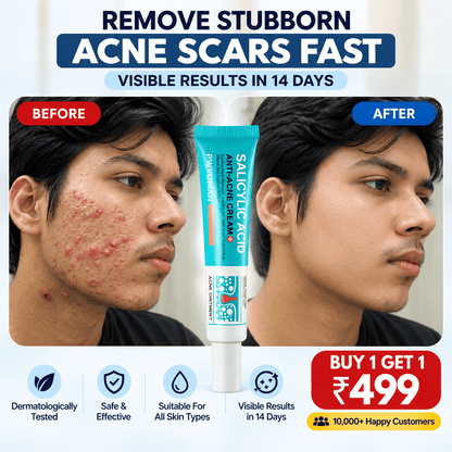 SD Salicylic Acid Anti-Acne Cream 💧 :  Acne-Free Glow - dmore