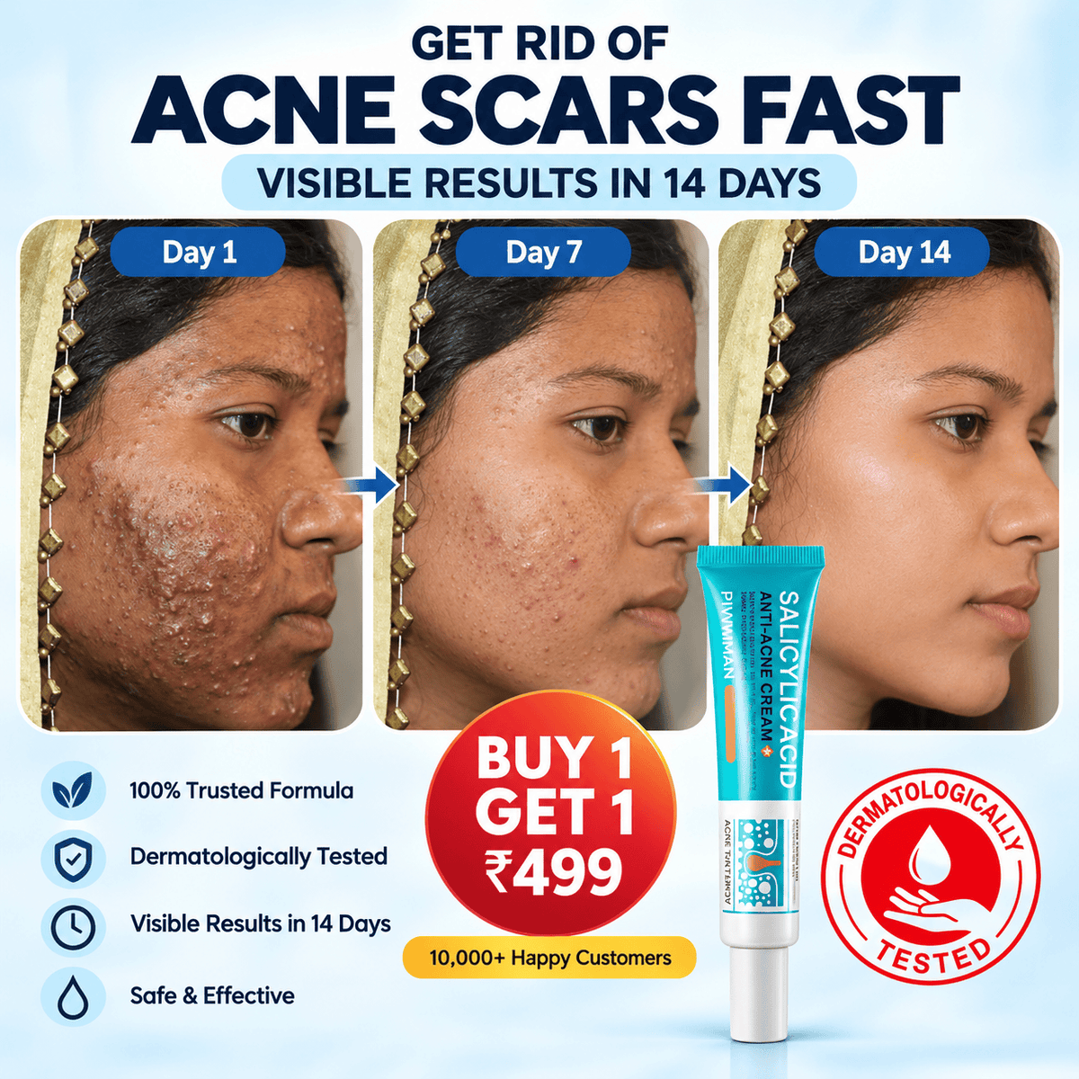 SD Salicylic Acid Anti-Acne Cream 💧 :  Acne-Free Glow - dmore