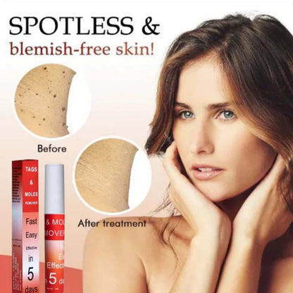 MD Mole & Tag Remover 🌿 Limited Time (Buy 1 Get 1 FREE)🔥Fast, Safe, Effective - dmore