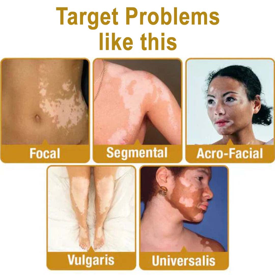 MD Bee Venom Vitiligo  Removal Cream Limited Time Only 💥Buy 1 Get 1 FREE 💥