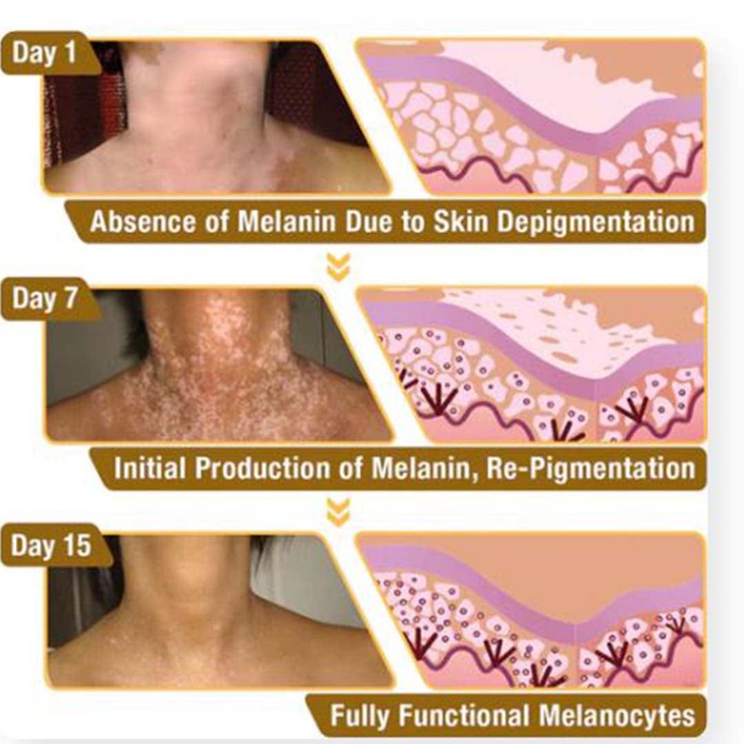 MD Bee Venom Vitiligo Removal Cream Limited Time Only 💥Buy 1 Get 1 FREE 💥