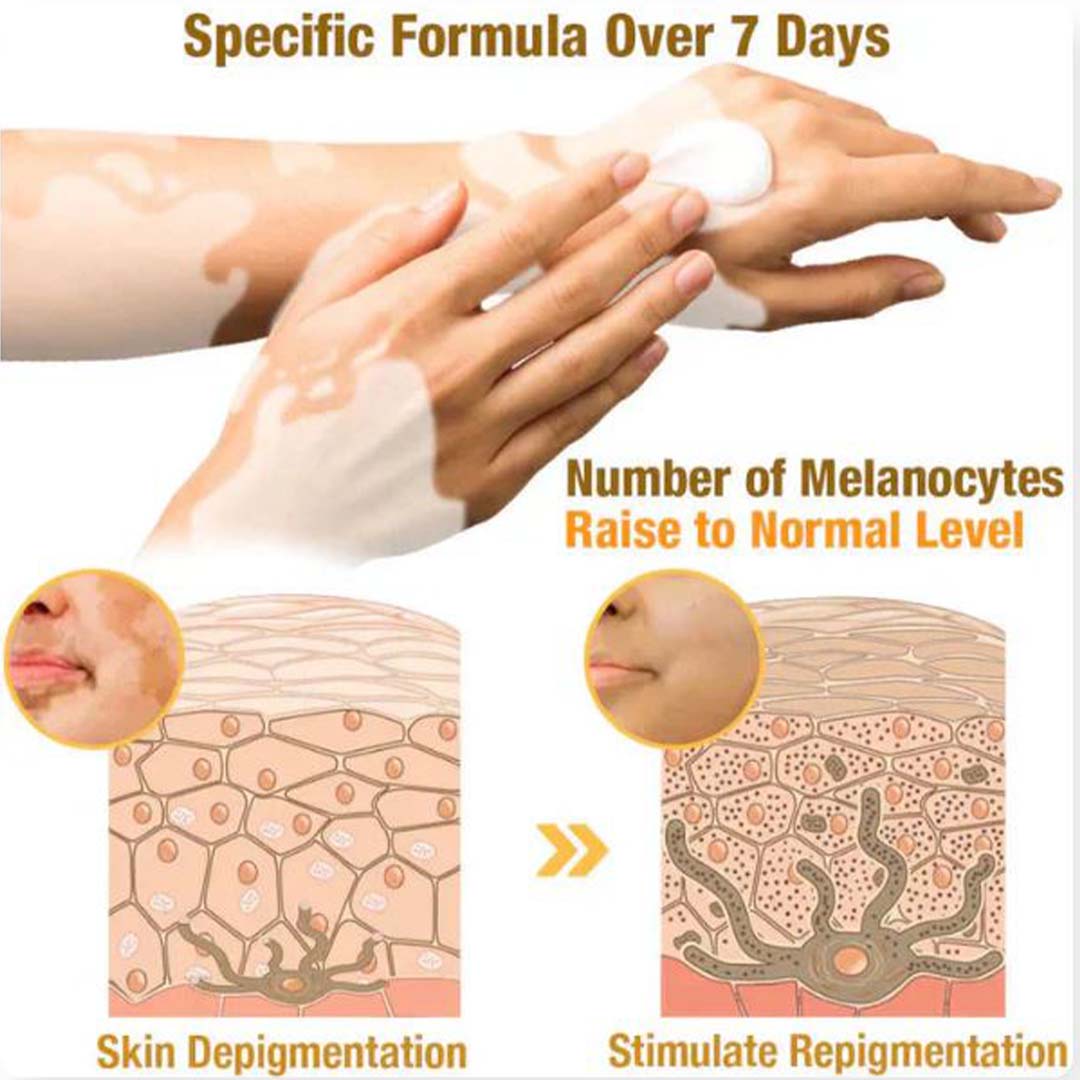 MD Bee Venom Vitiligo Removal Cream Limited Time Only 💥Buy 1 Get 1 FREE 💥