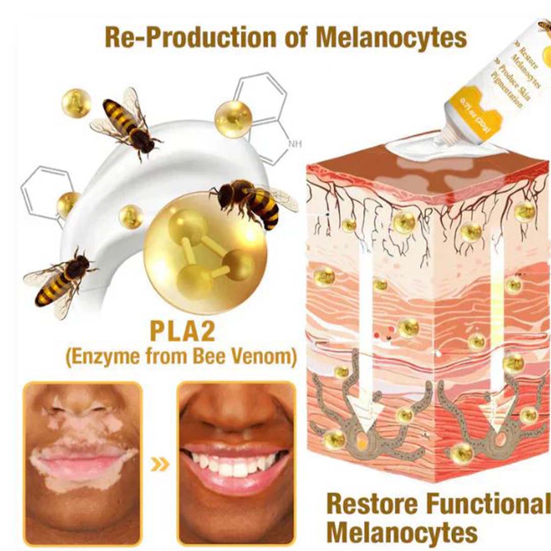 MD Bee Venom Vitiligo  Removal Cream Limited Time Only 💥Buy 1 Get 1 FREE 💥