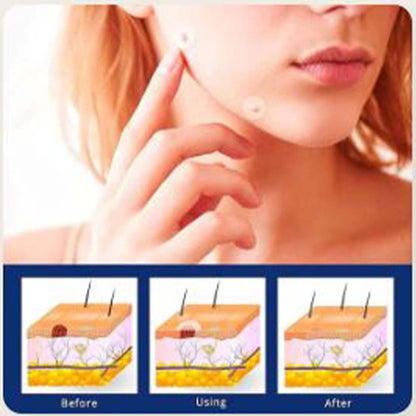 ✨ SD Flawless Skin in Weeks – Bee Venom Tag & Wart Remover  ✨ - dmore